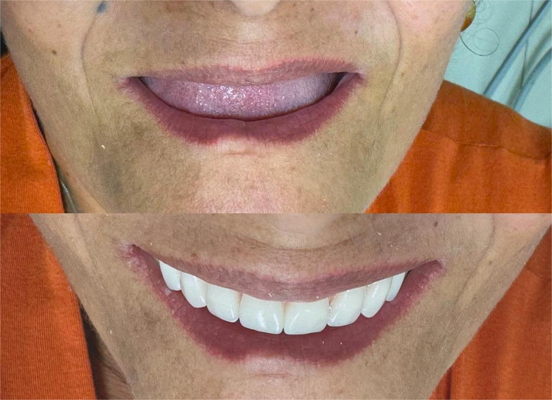 Antes e depois do tratamento odontológico