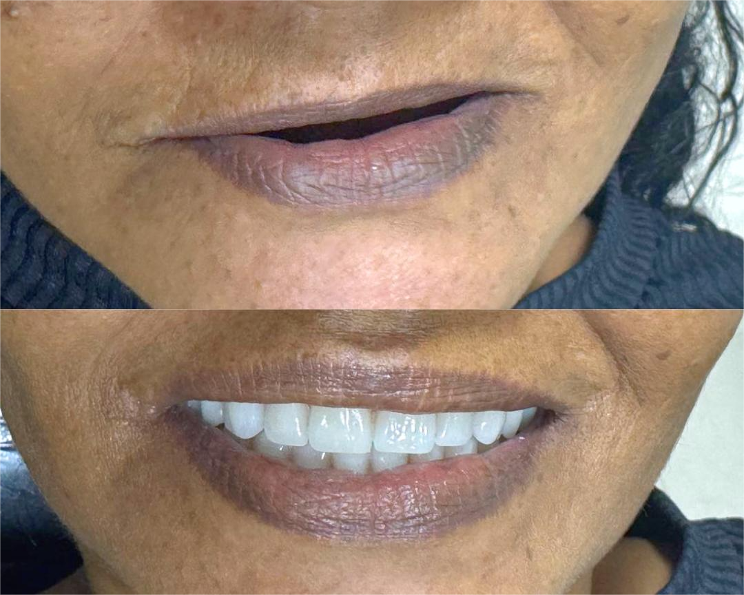 Resultado de implante dentário